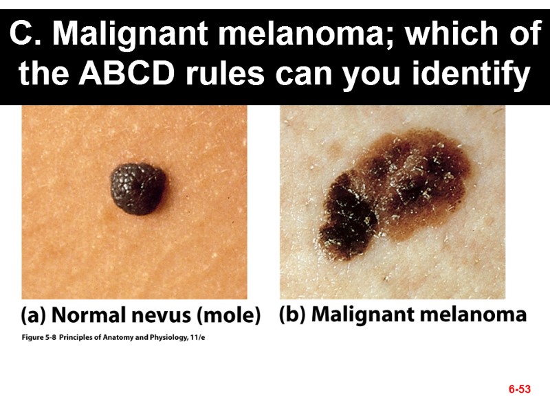 C. Malignant melanoma; which of the ABCD rules can you identify 6-53